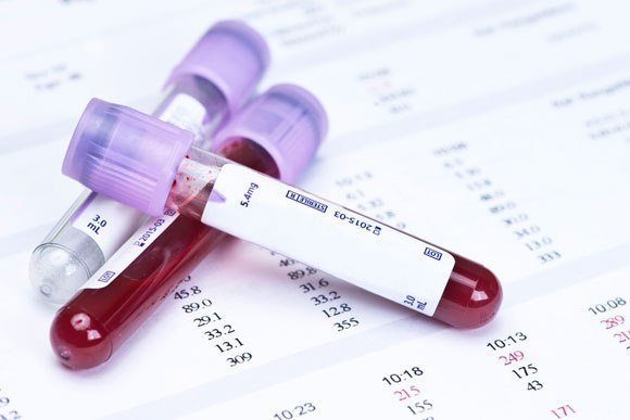 Um hemograma completo pode indicar alterações importantes nos glóbulos vermelhos, brancos e plaquetas. 📊 Caso já tenha um exame recente, verifique se há anemia, plaquetas baixas ou qualquer outra alteração.